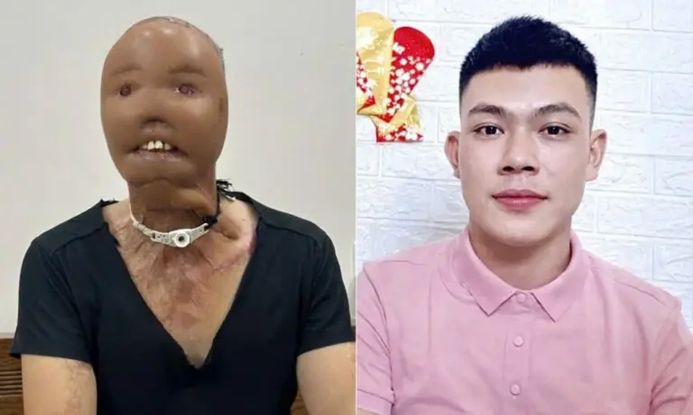 Thắng trước (phải) và sau khi được phẫu thuật mặt hồi đầu năm nay. Ảnh: Ngọ Đặng/Nguyễn Văn Thắng